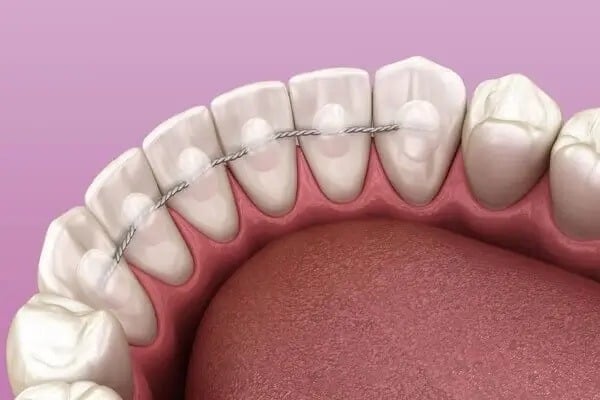 Pekiştirme Tedavisi (Retansiyon)